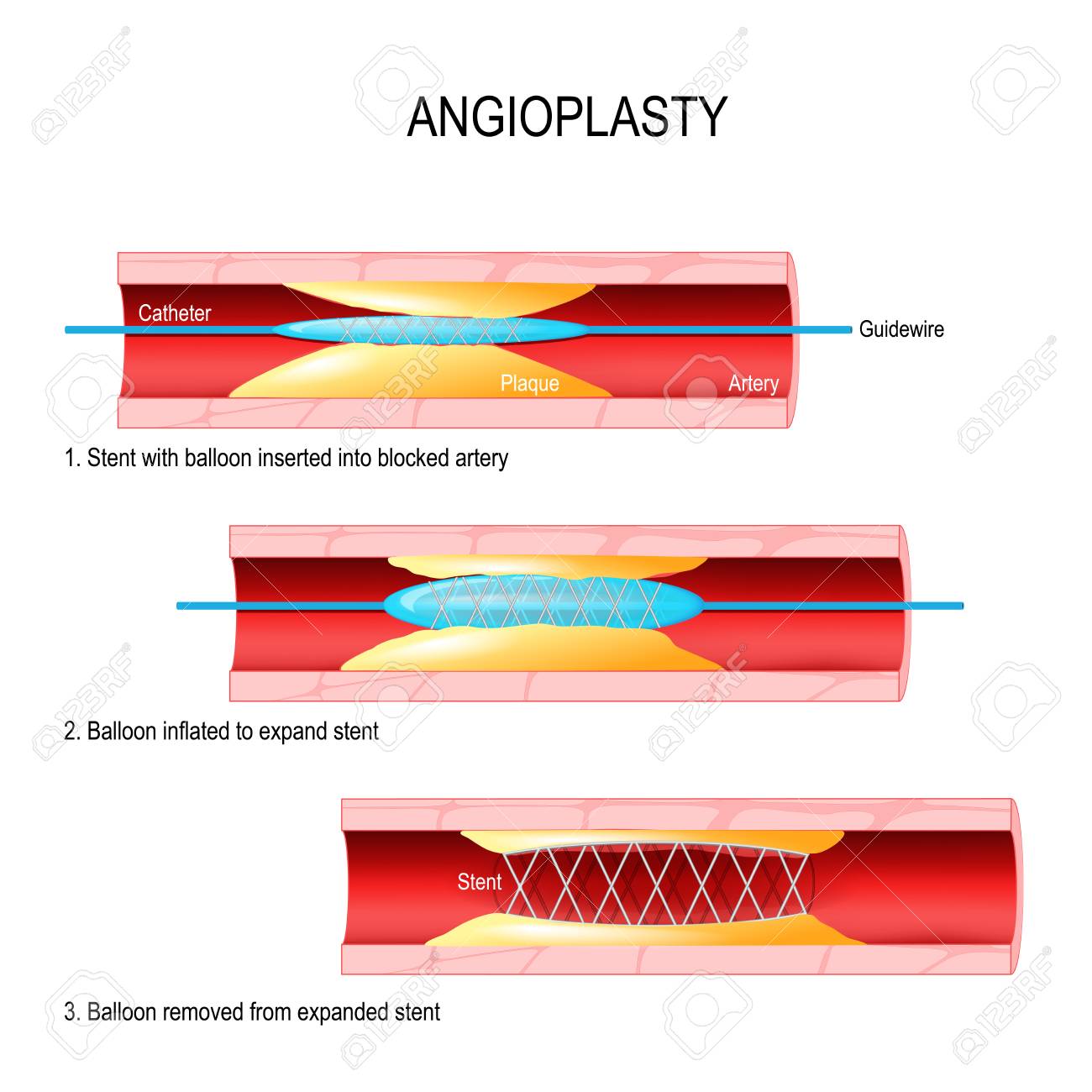 Angioplasty. Stent Implantation. Deflated balloon catheter inserted into a coronary artery narrowed by plaque. the balloon is inflated, compressing the plaque against the artery wall. Stents - tubes made of metal mesh. The stent remains in the artery after the procedure to help keep the artery open. - 90514051 Angioplasty. Stent Implantation. Deflated balloon catheter inserted into a coronary artery narrowed by plaque. the balloon is inflated, compressing the plaque against the artery wall. Stents - tubes made of metal mesh. The stent remains in the artery after the procedure to help keep the artery open. - 90514051