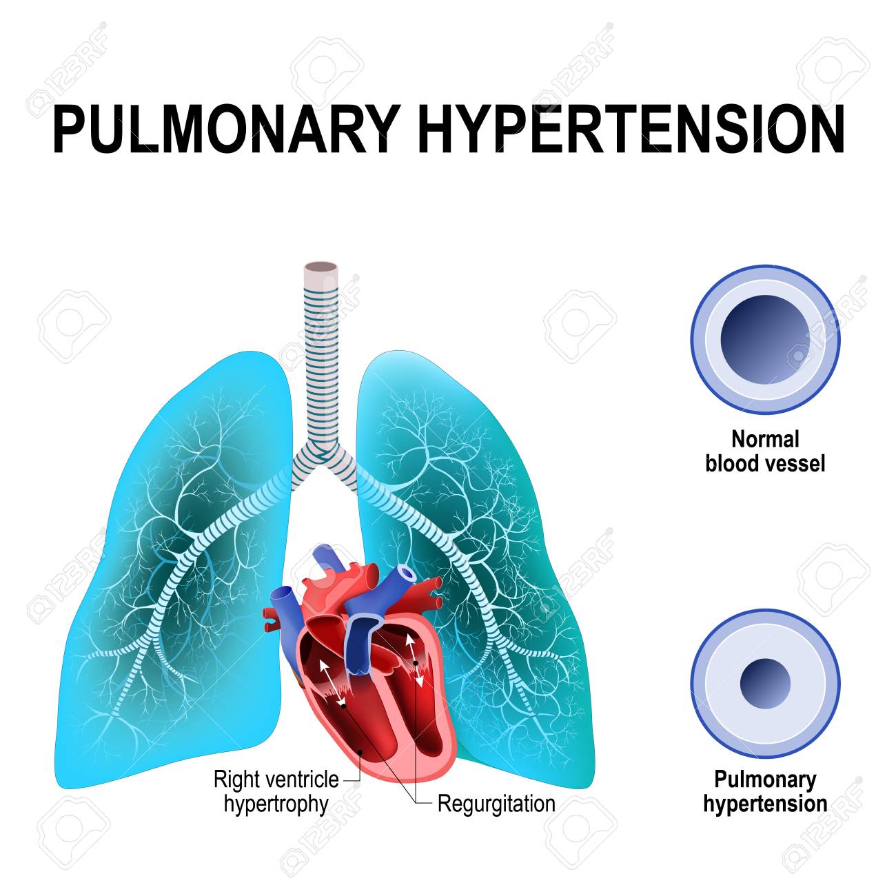Pulmonary hypertension is an increased blood pressure within the arteries of the lungs. Cross section of the Normal, and narrowing of blood vessels. Humans heart with hypertrophy of Right ventricle and pulmonic regurgitation - 92261705 Pulmonary hypertension is an increased blood pressure within the arteries of the lungs. Cross section of the Normal, and narrowing of blood vessels. Humans heart with hypertrophy of Right ventricle and pulmonic regurgitation - 92261705