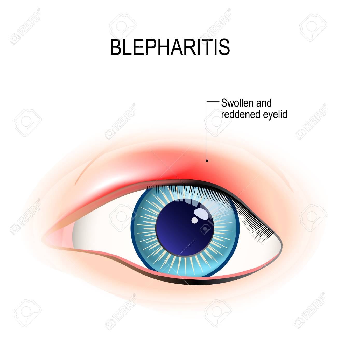 Eye of human. Blepharitis is a inflammation, and reddening of the eyelid. Human anatomy. Vector diagram for educational, and medical use. - 92465885 Eye of human. Blepharitis is a inflammation, and reddening of the eyelid. Human anatomy. Vector diagram for educational, and medical use. - 92465885