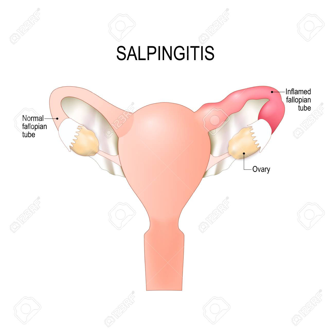 Image result for salpingitis