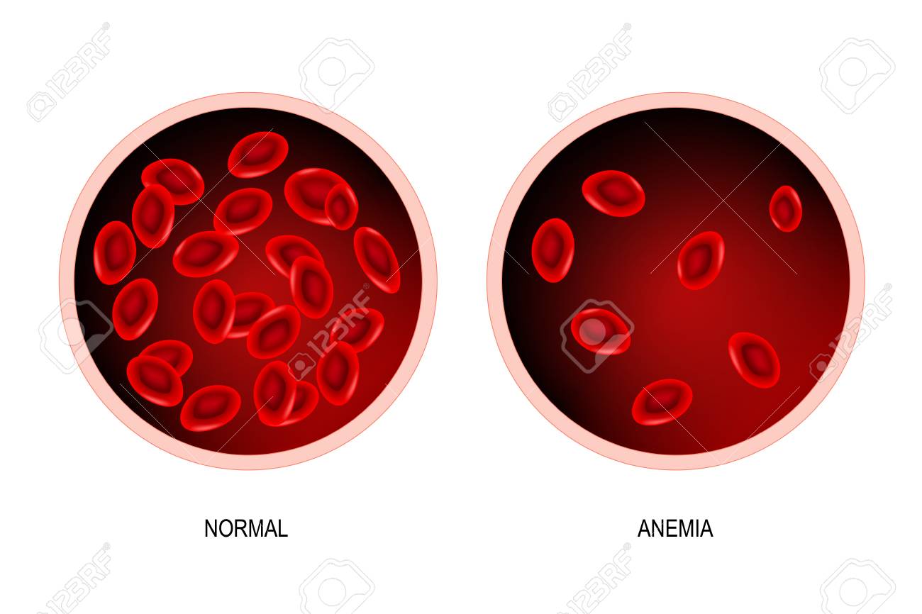 blood of healthy human and blood vessel with anemia. Anemia is a decrease in the total amount of red blood cells or hemoglobin in the blood. Vector illustration. - 103865198 blood of healthy human and blood vessel with anemia. Anemia is a decrease in the total amount of red blood cells or hemoglobin in the blood. Vector illustration. - 103865198