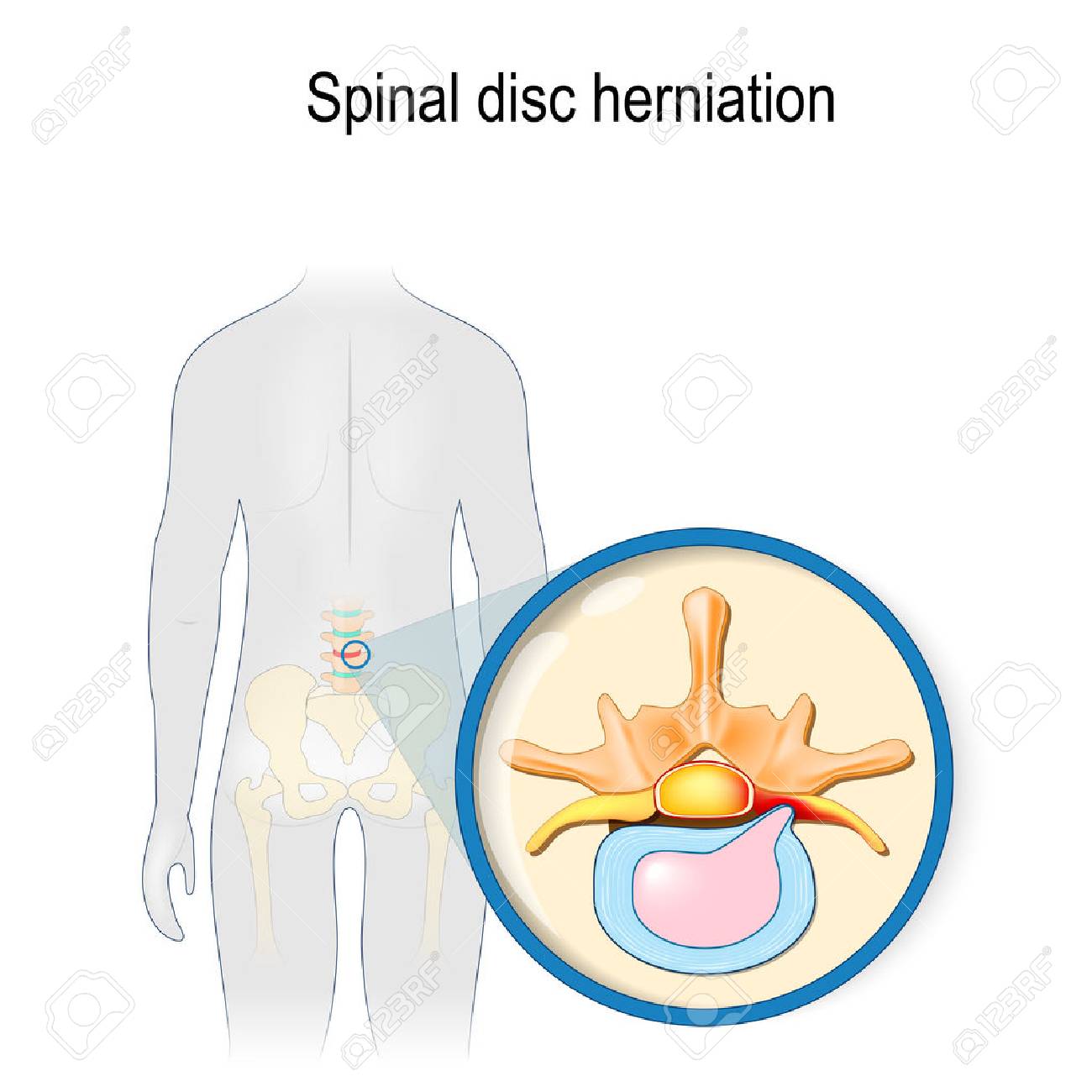 Spinal disc herniation. Back pain. Human silhouette with highlighted (red color) lumbar spine and Pelvis. Prolapse of intervertebral disc close-up. Vector illustration for your design, educational, biology, scientific, and medical use. - 119627976 Spinal disc herniation. Back pain. Human silhouette with highlighted (red color) lumbar spine and Pelvis. Prolapse of intervertebral disc close-up. Vector illustration for your design, educational, biology, scientific, and medical use. - 119627976