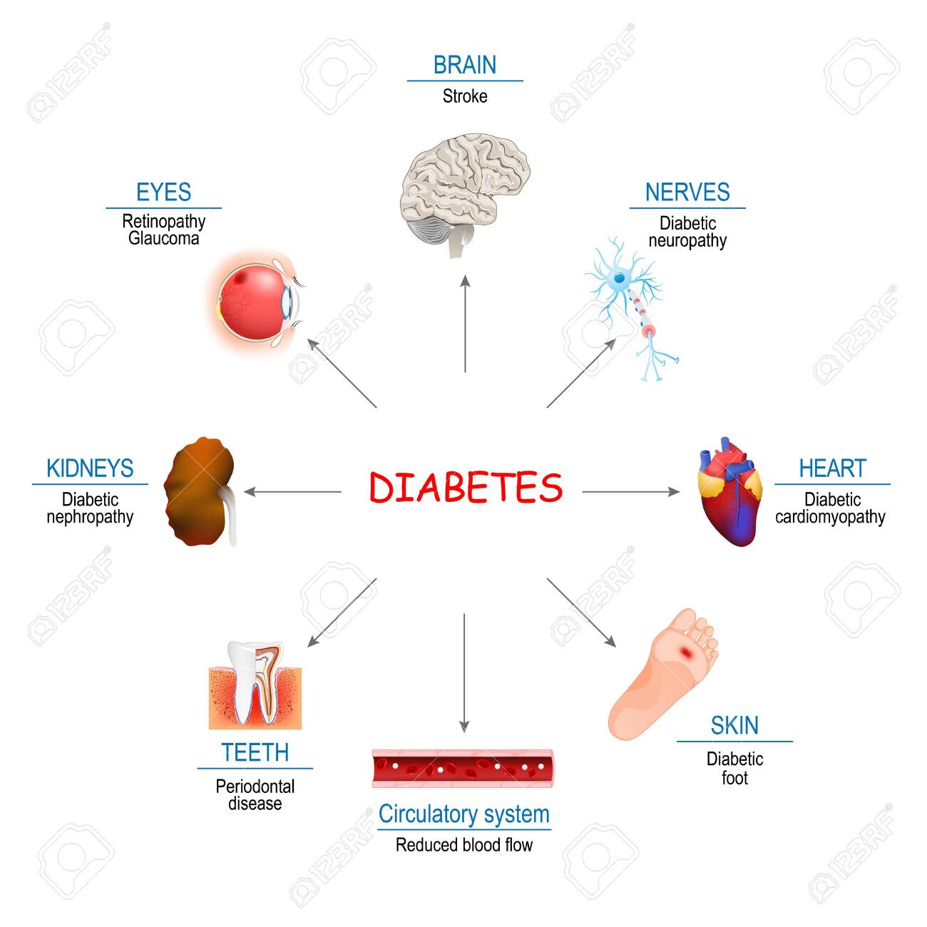 en diabetes mellitus en diabetes mellitus