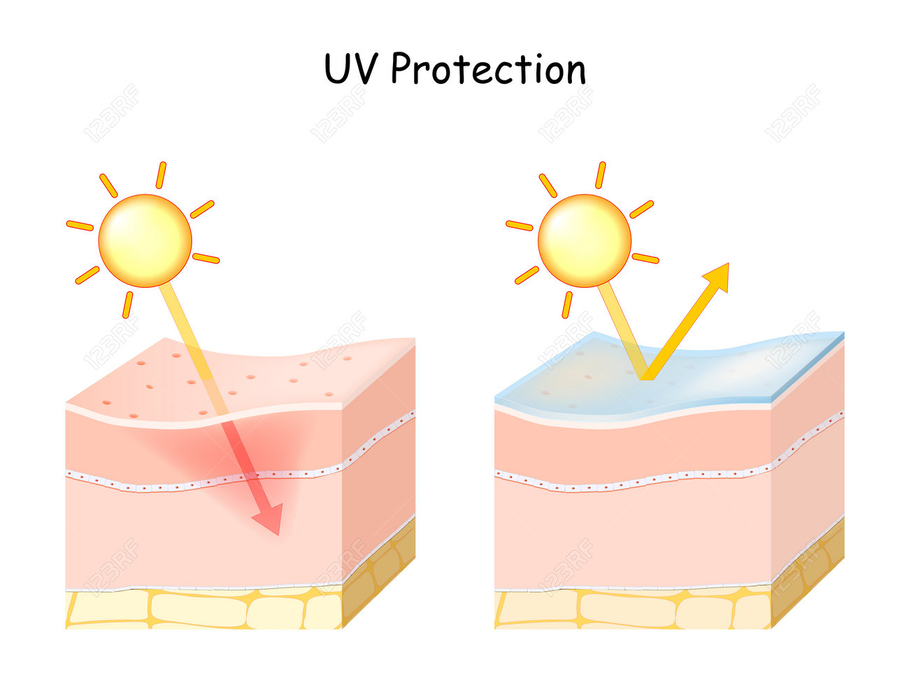 Protection Contre Les Rayons Uv Pour Les Peaux Sensibles. Comparaison Et  Différence Entre La Peau Avec Une Crème Solaire Et La Peau Sans Crème  Solaire Clip Art Libres De Droits, Svg, Vecteurs
