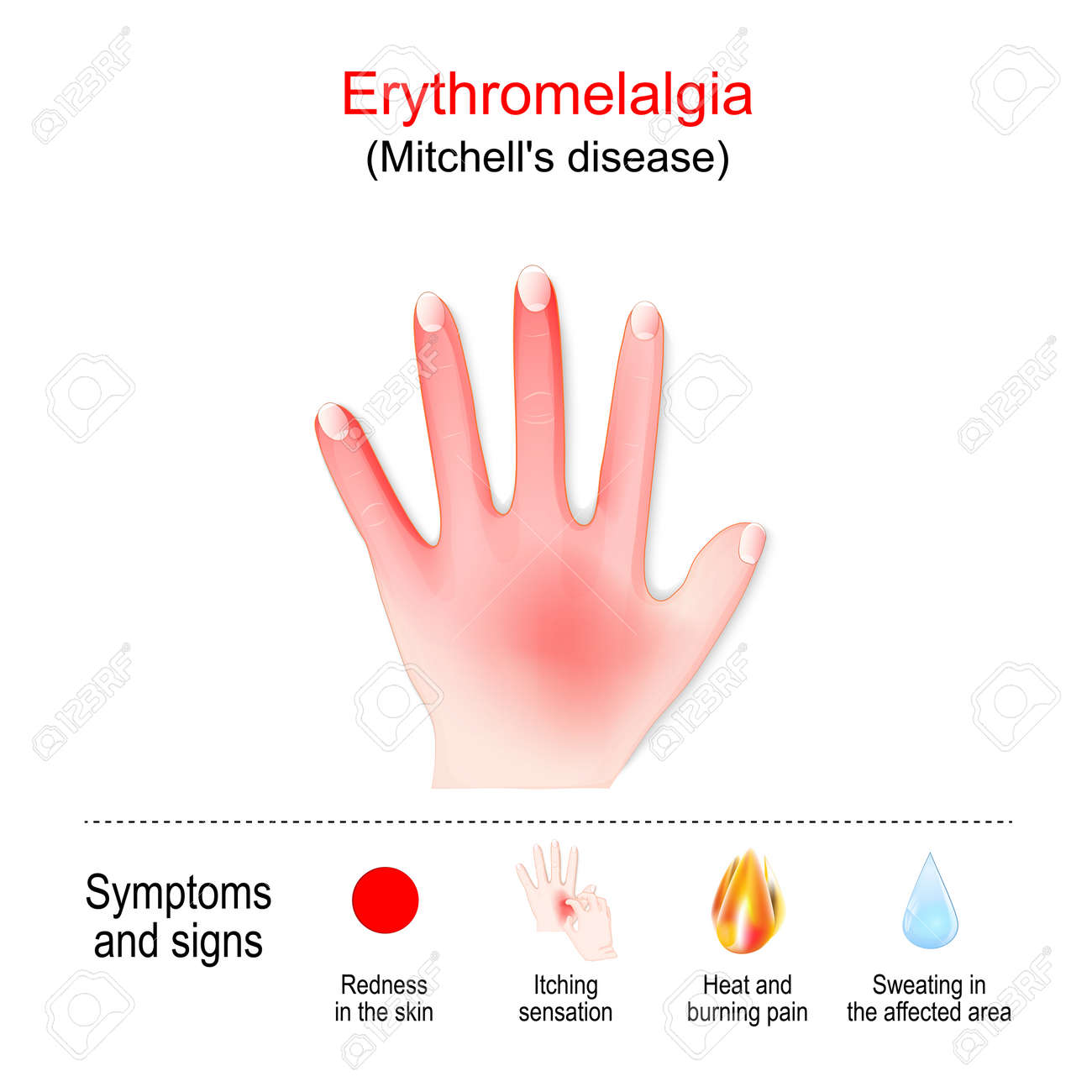 Erythromelalgia is a rare condition that causes episodes of burning pain and redness in the hands and other body parts. Mitchell's disease in left hand. Symptoms and signs of Erythromelalgia. vector poster - 184978153 Erythromelalgia is a rare condition that causes episodes of burning pain and redness in the hands and other body parts. Mitchell's disease in left hand. Symptoms and signs of Erythromelalgia. vector poster - 184978153