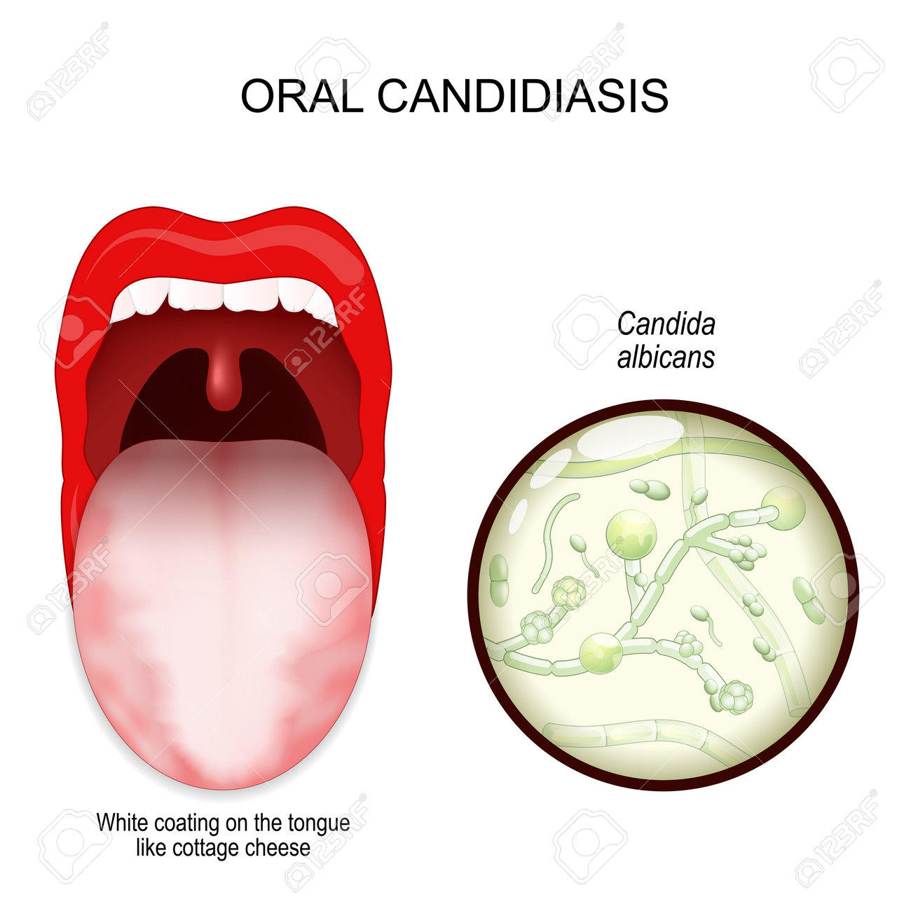 Oral Candidiasis. Oral Thrush Yeast Infection. White Coating On The Tongue  Like Cottage Cheese. Close-up Of A Fungi Candida Albicans. Vector  Illustration Royalty Free SVG, Cliparts, Vectors, and Stock Illustration.  Image 194026640., image size:1300x1300