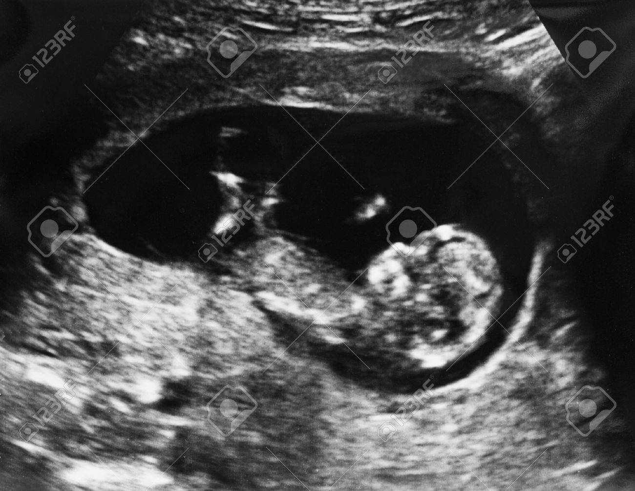 Echographie Du Foetus De 3 Mois Dans L Uterus Banque D Images Et Photos Libres De Droits Image