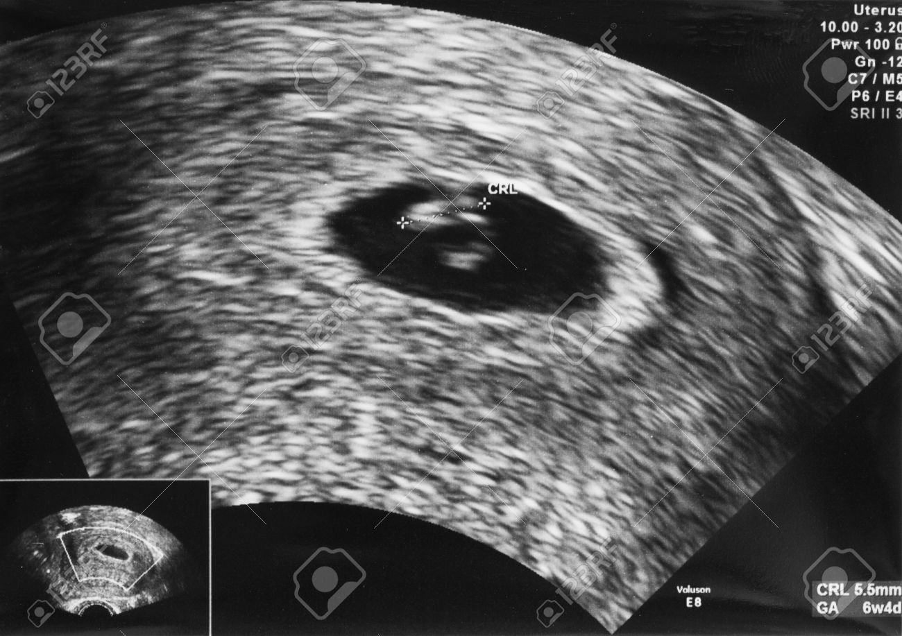 L Image Par Ultrasons D Un Embryon A L Age De 6 Semaines Et 4 Jours Banque D Images Et Photos Libres De Droits Image