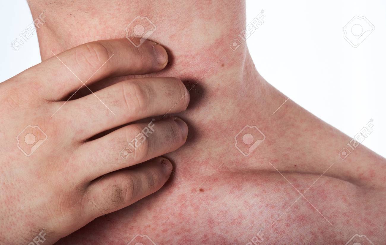 man scratching his neck with rash isolated on white - 61270341 man scratching his neck with rash isolated on white - 61270341