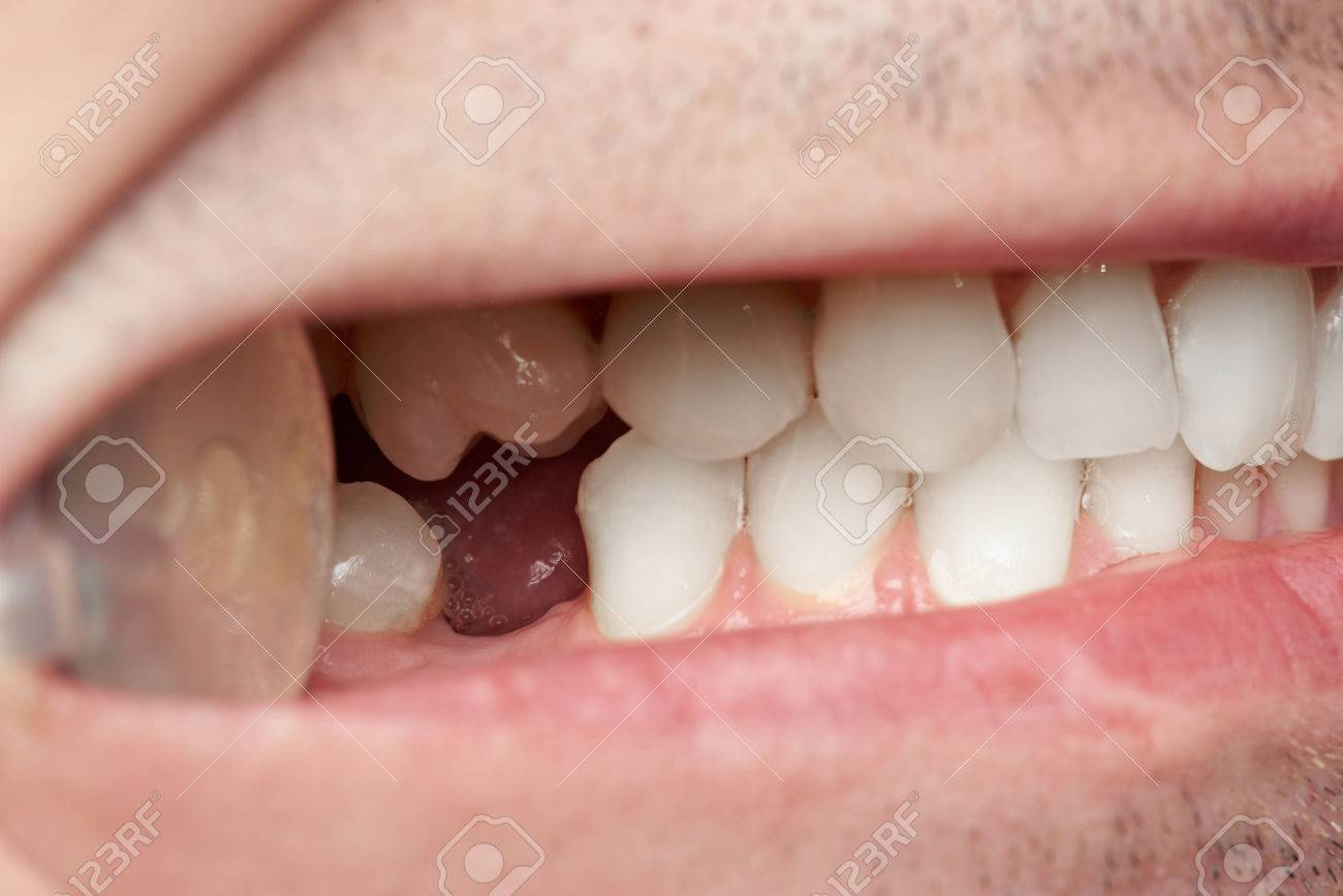 Teeth with gap of missing tooth close-up. Doctor man checking teeth - 80874046 Teeth with gap of missing tooth close-up. Doctor man checking teeth - 80874046