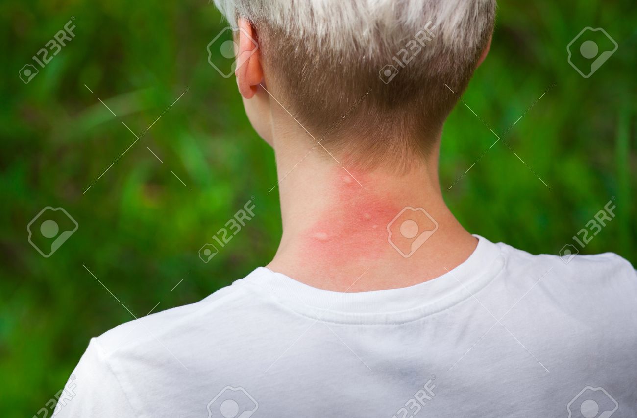 peau du cou rouge peau du cou rouge