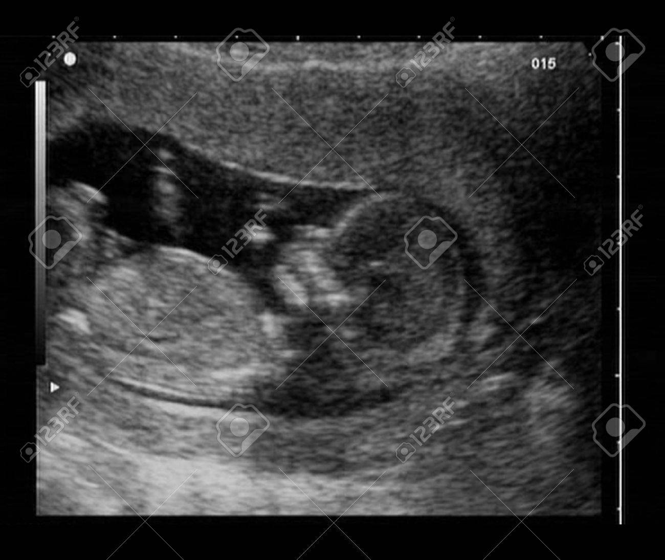 Foetus Echographie A 12 Semaines Banque D Images Et Photos Libres De Droits Image