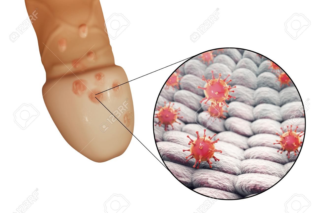 What Does Herpes Look Like - Pictures of STDs What Does Herpes Look Like - Pictures of STDs
