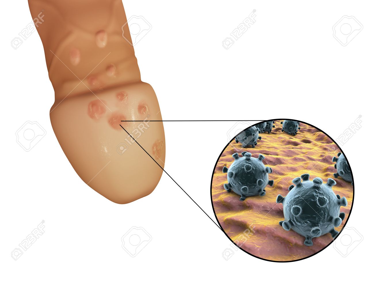 Herpes - Herpes Pictures and Cold Sores Pictures Herpes - Herpes Pictures and Cold Sores Pictures