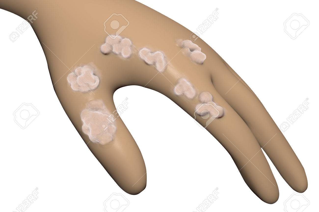 virus papiloma humano en la mano