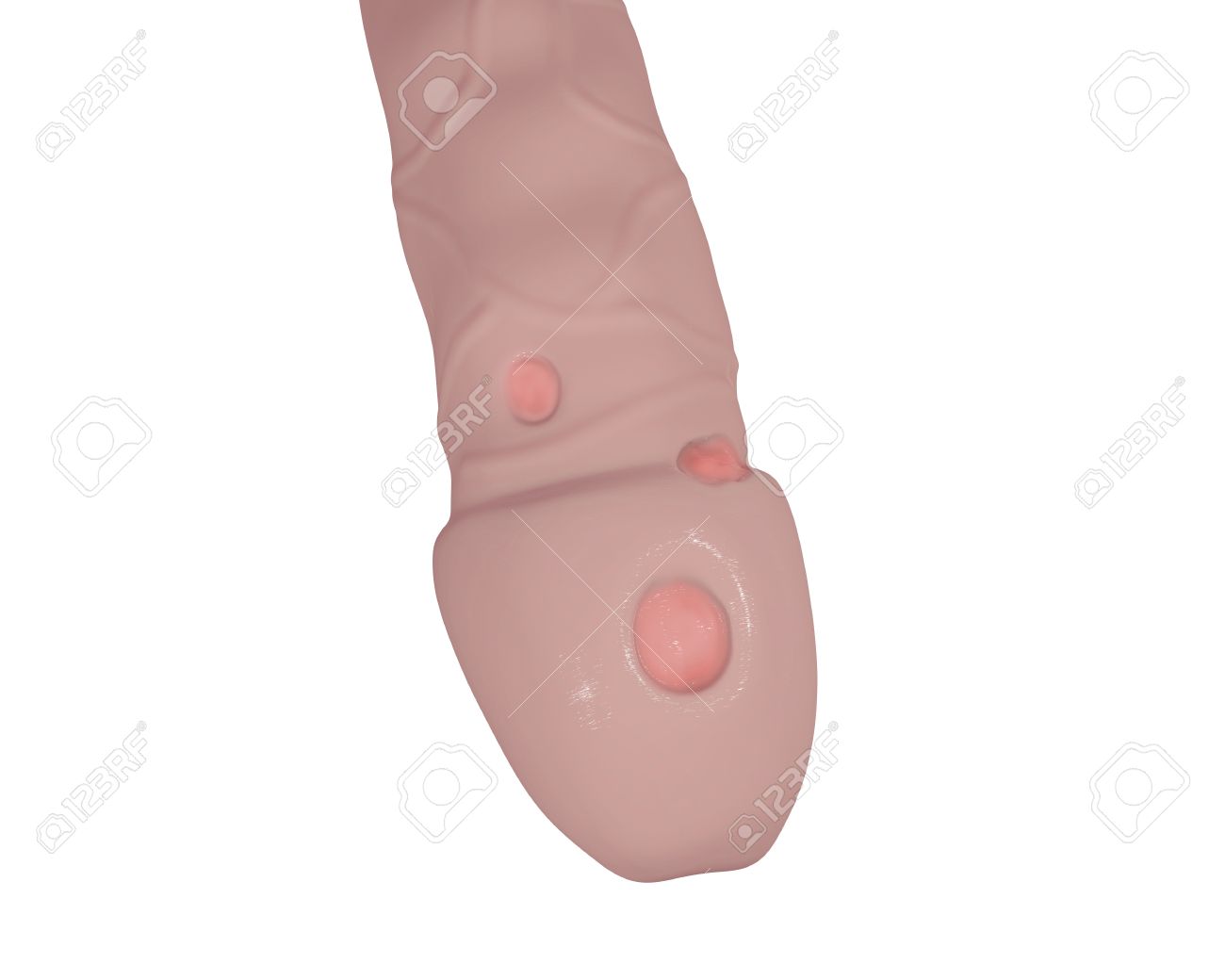 white ulcer penis White ulcer penis