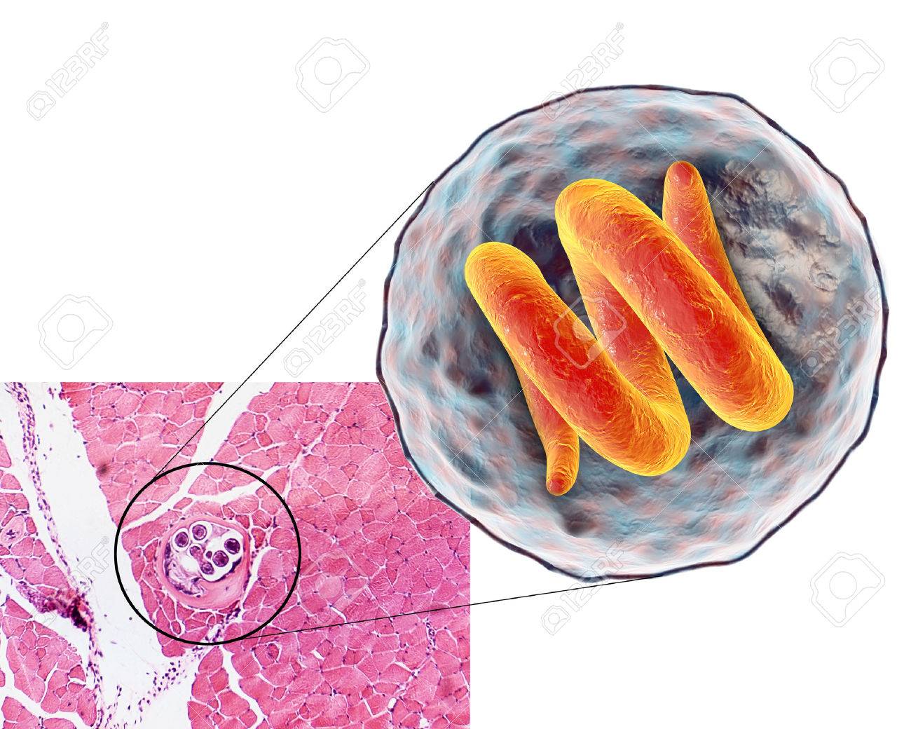 Helminth trichinosis, Helminth trichinosis Opisthorchiasis tünetek krónikus hasmenés