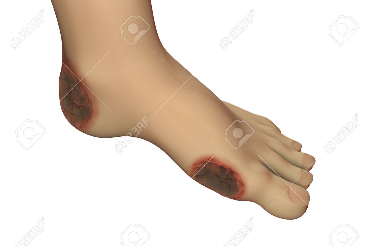ulcere pieds diabetique ulcere pieds diabetique