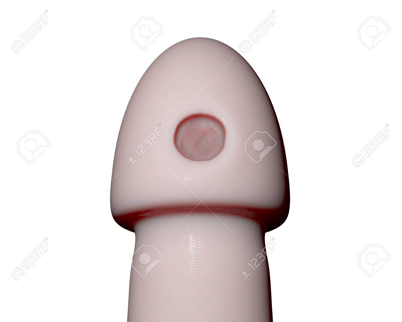 white ulcer penis White ulcer penis