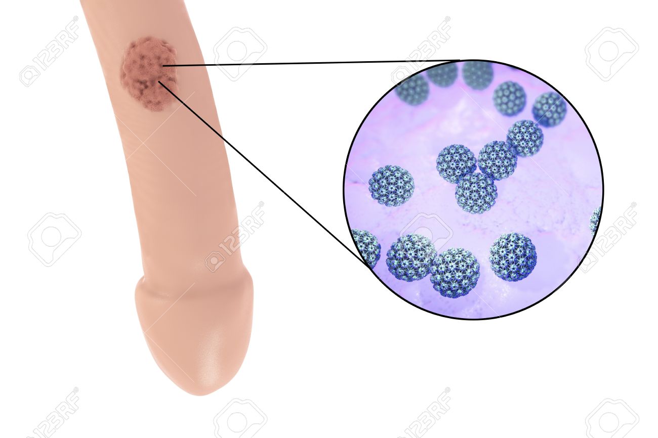 Human papillomavirus infection vs genital warts