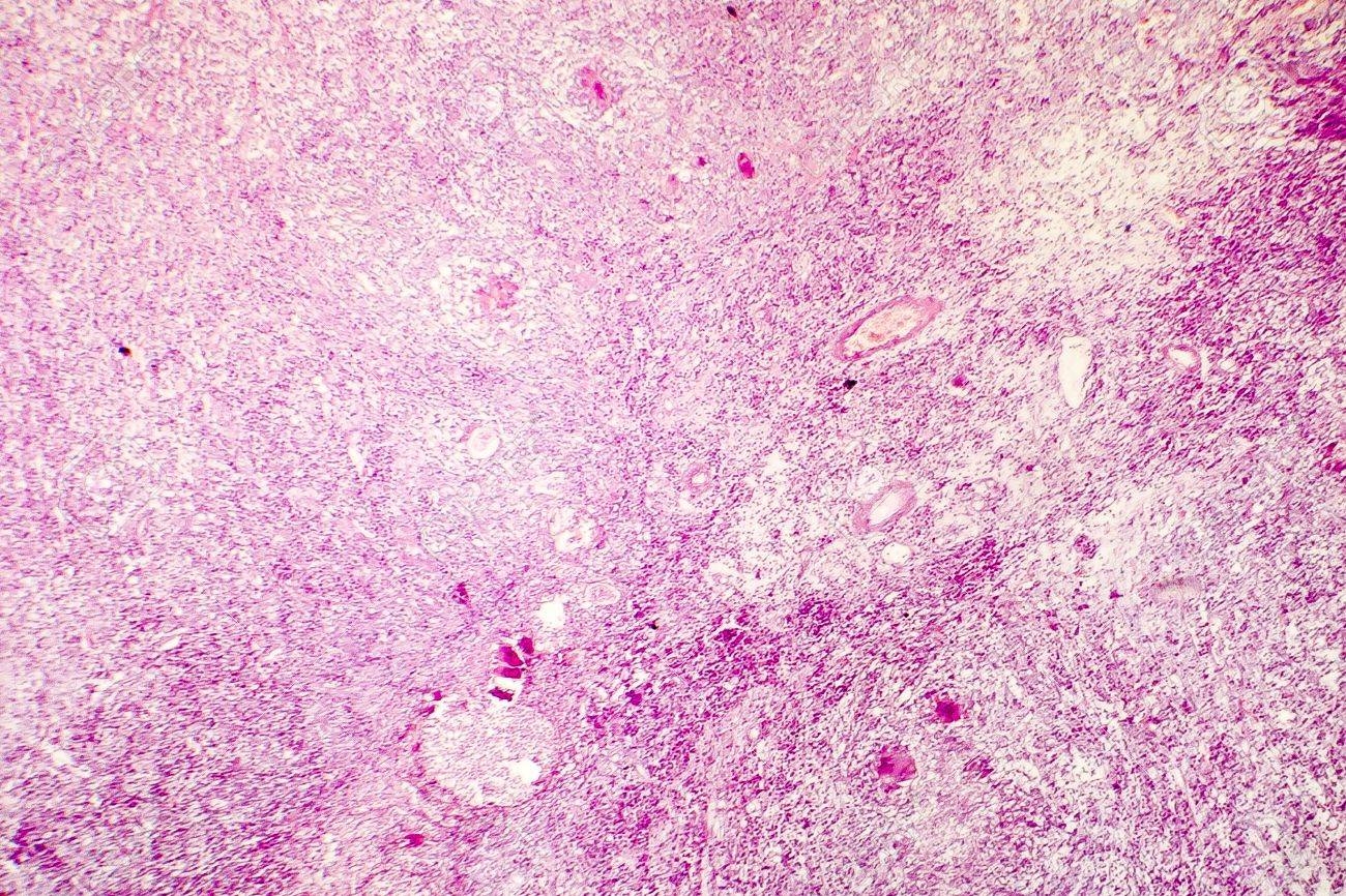 Liquefactive Necrosis Of The Human Brain, Light Photomicrograph Showing  Loss Of Cell Outlines, Accumulation Of Cellular Debris, Macrophage  Infiltration. Developes In Stroke, Necrotising Encephalitis Stock Photo,  Picture And Royalty Free Image. Image