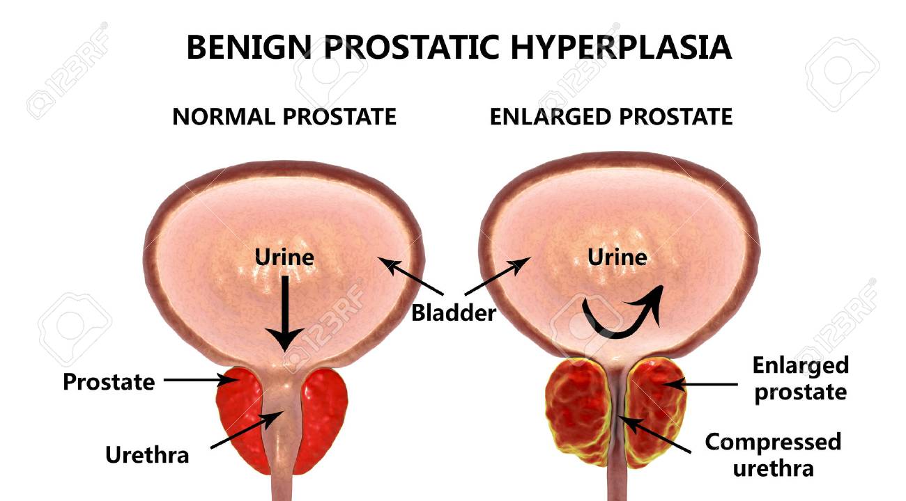 que es la prostata agrandada