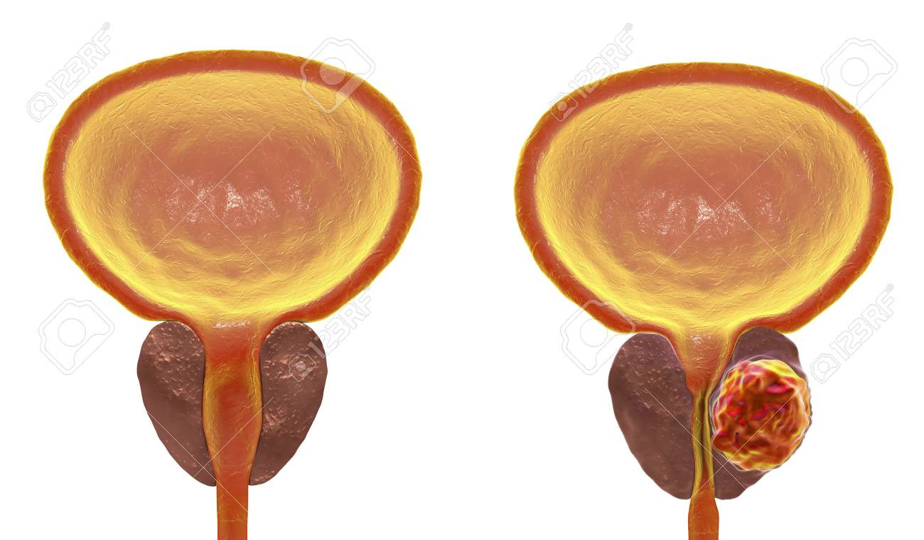 前立腺癌 3 D イラスト表示通常 前立腺と尿道を圧縮前立腺内の腫瘍の存在 ラベル イメージ の写真素材 画像素材 Image 前立腺癌 3 D イラスト表示通常 前立腺と尿道を圧縮前立腺内の腫瘍の存在 ラベル イメージ の写真素材 画像素材 Image