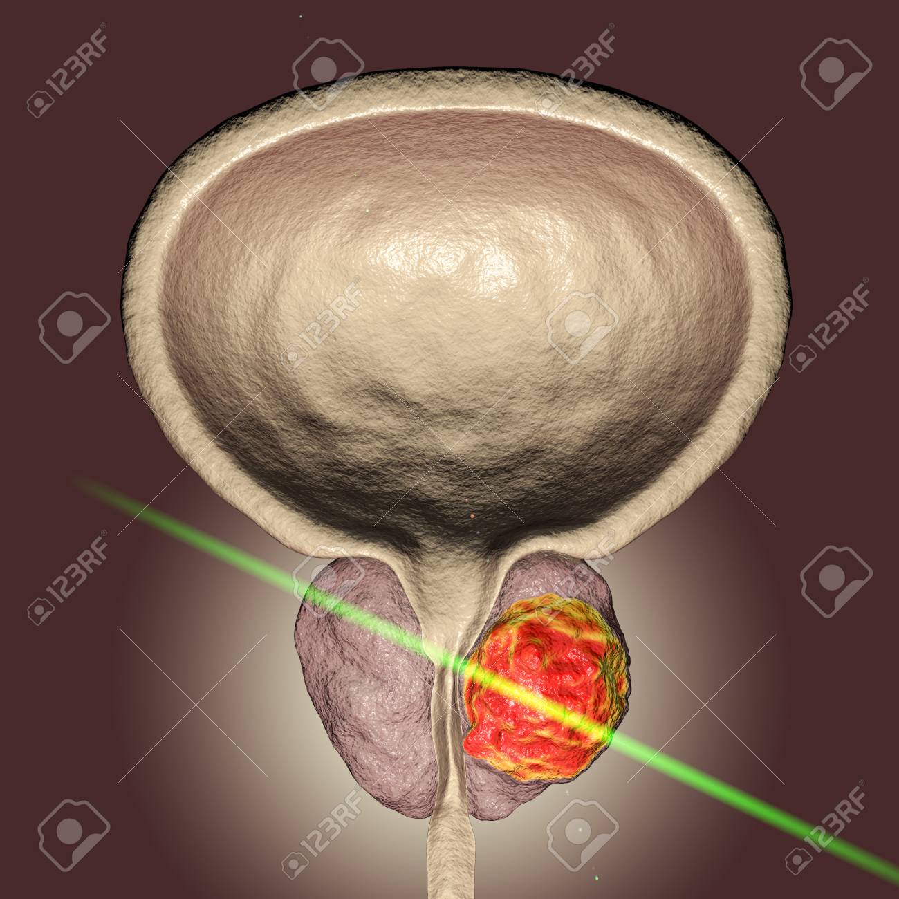 Hiperplazia benignă de prostată