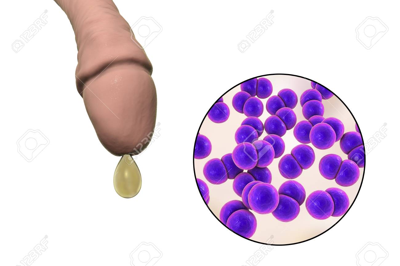 Squirting uretre