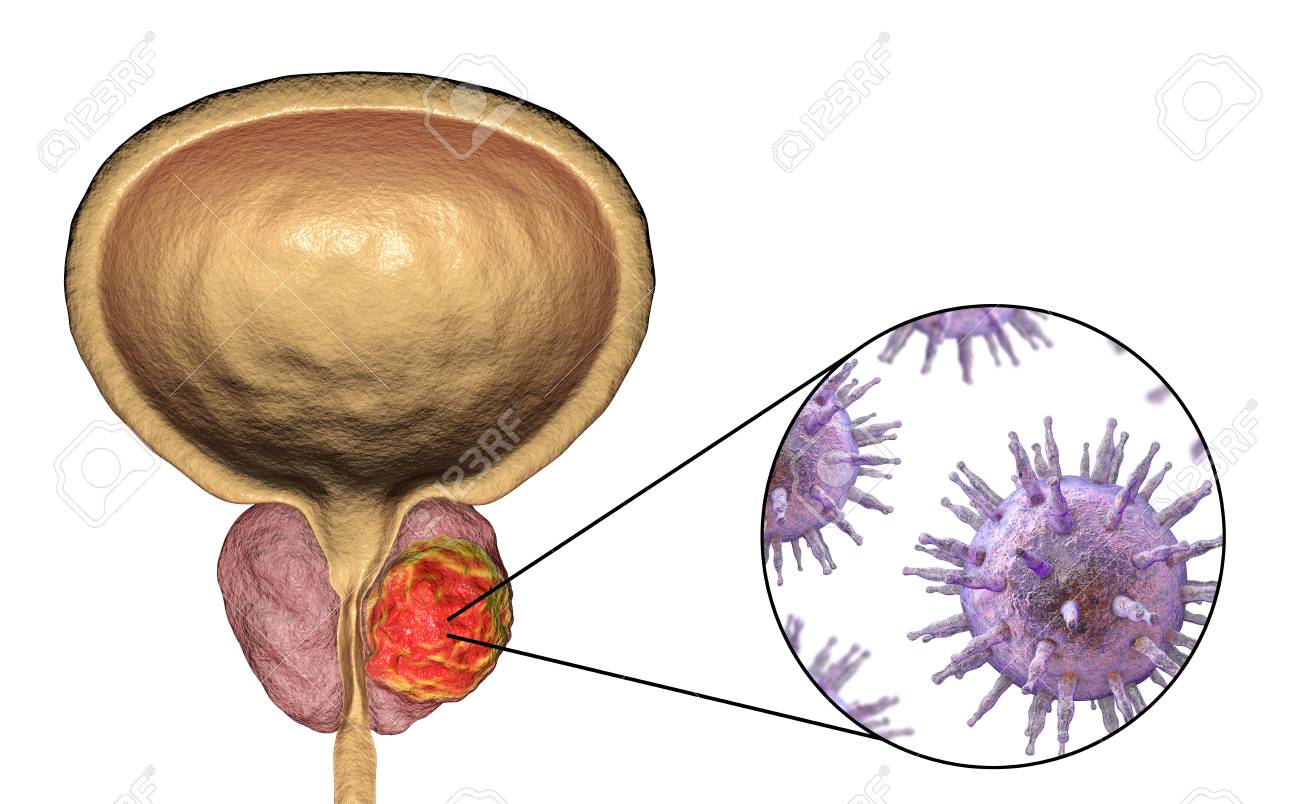 imagenes de cancer a la prostata