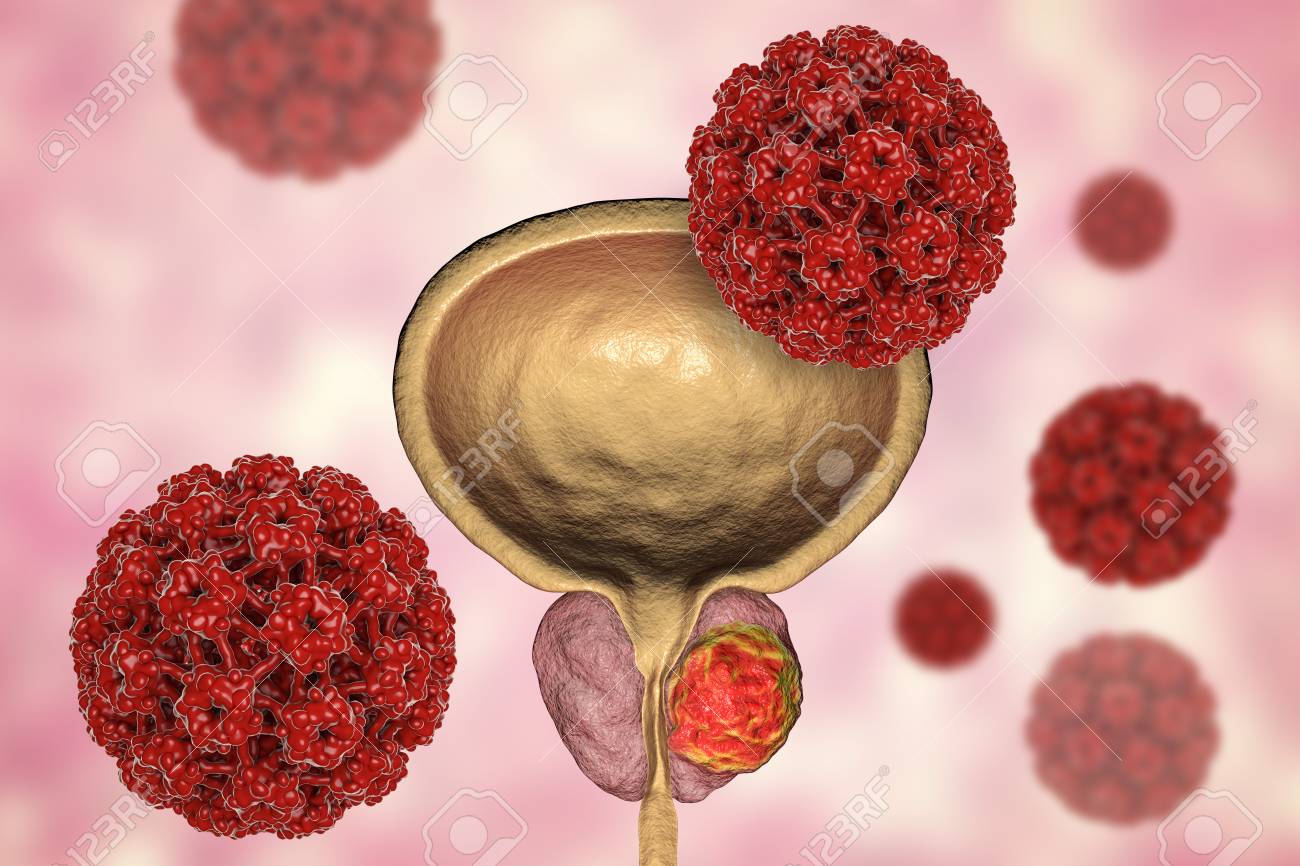 hpv virus prostate cancer