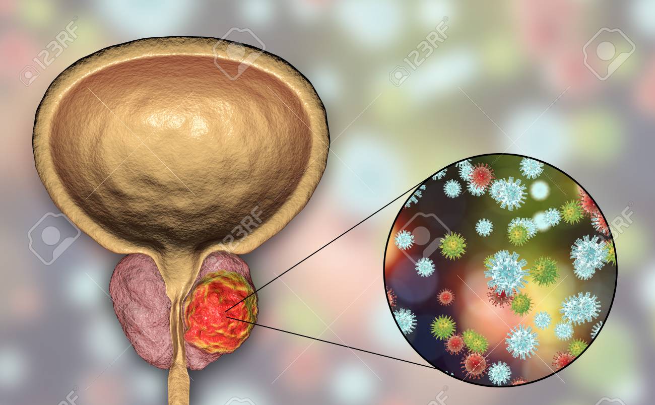 ¿Puede su próstata infectarse? ¿Puede su próstata infectarse?