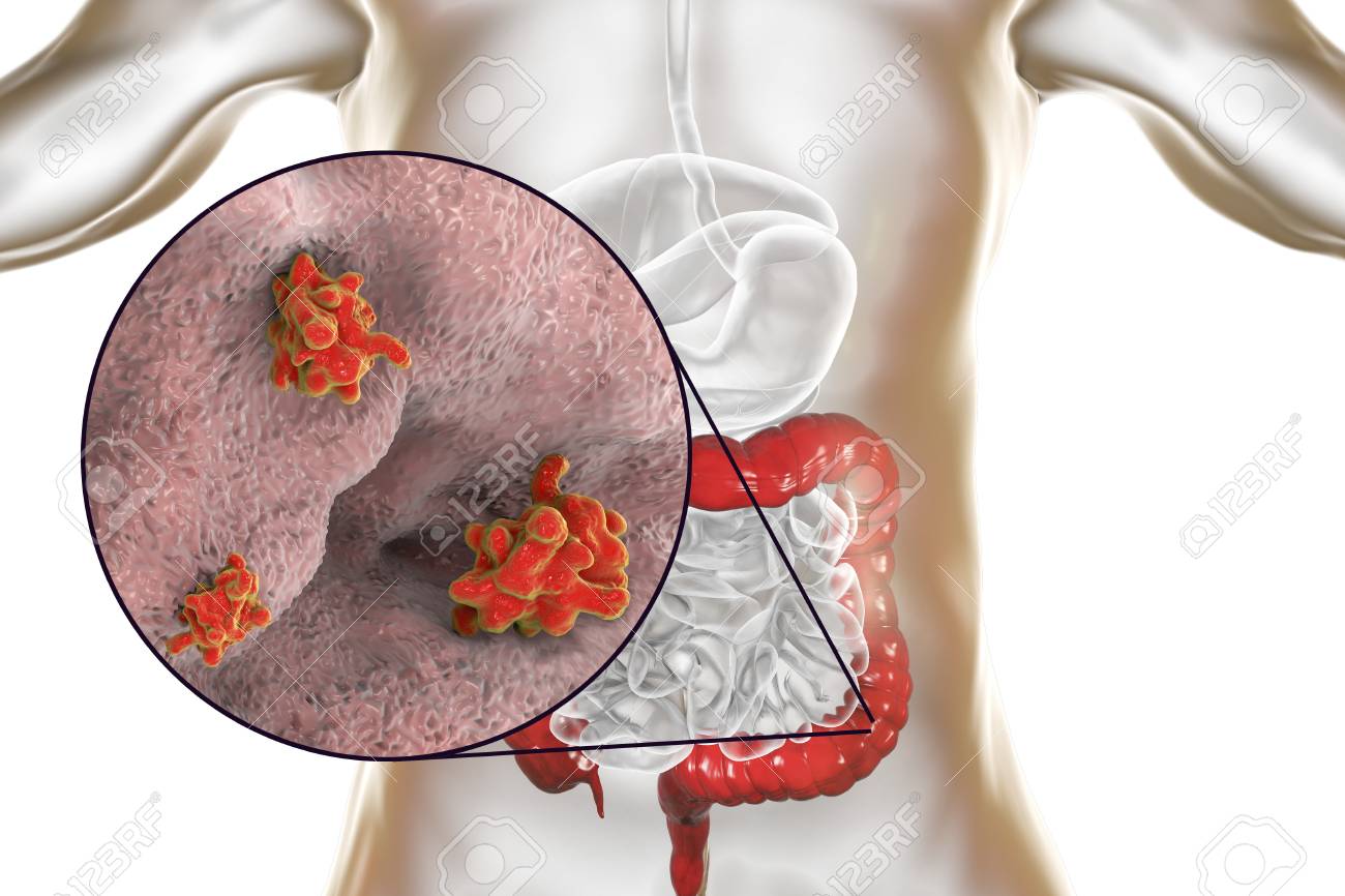 dysenteric améba parazita