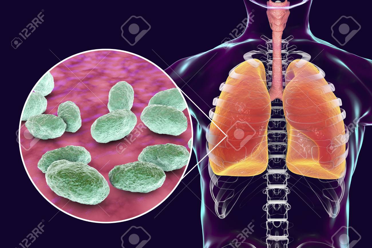 pneumonia caused by haemophilus influenzae bacteria medical stock haemophilus influenzae