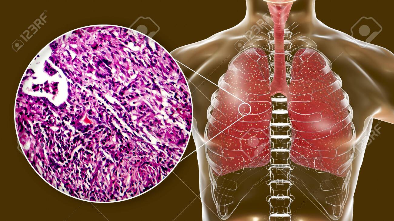 Miliary Tuberculosis, 3D Illustration And Light Micrograph Showing  Histopathology Of The Lung Affected By Multiple Tiny Tuberculosis Lesions  Stock Photo, Picture and Royalty Free Image. Image 128015492., image size:1300x731