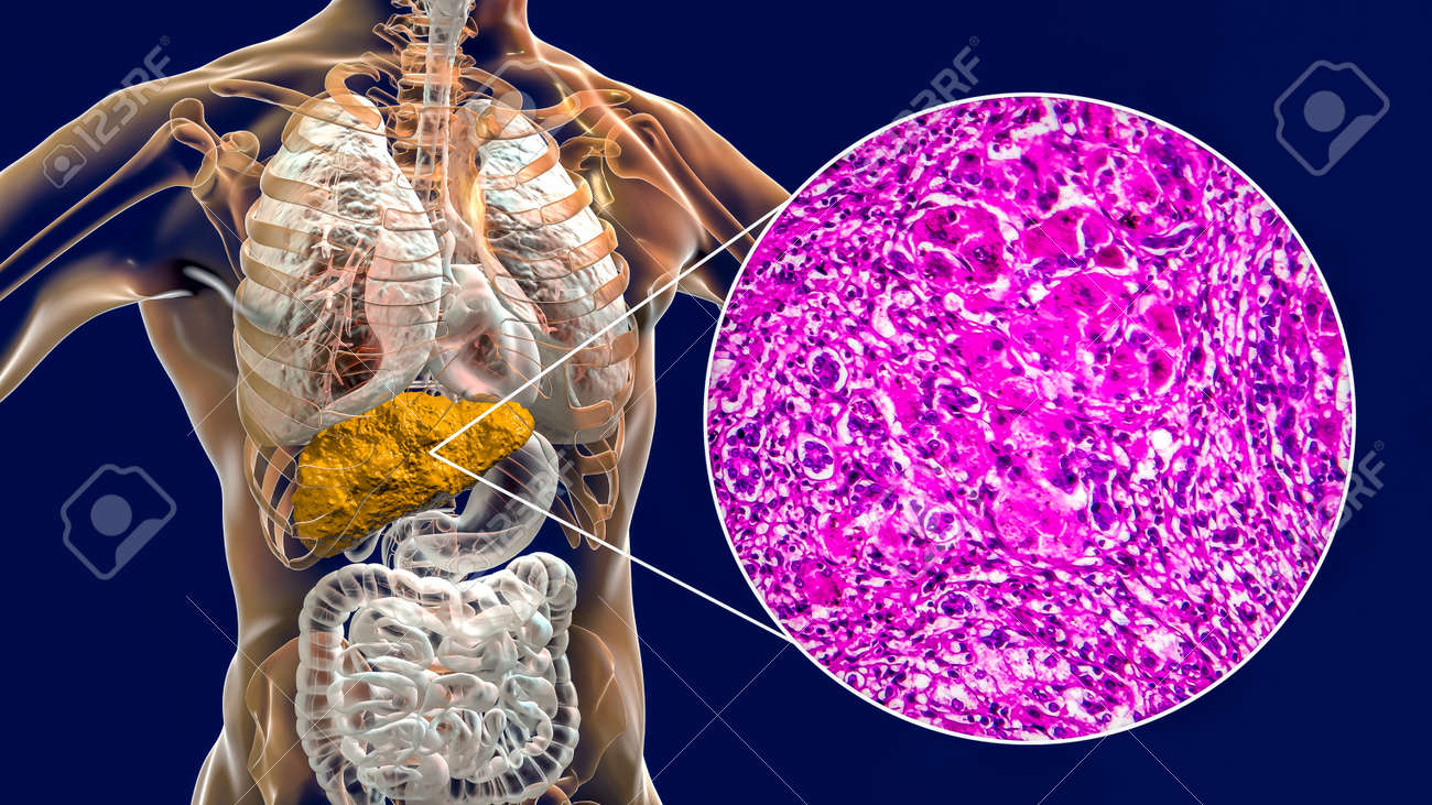 Liver with cirrhosis inside human body. 3D illustration and light micrograph of portal cirrhosis - 157016653 Liver with cirrhosis inside human body. 3D illustration and light micrograph of portal cirrhosis - 157016653