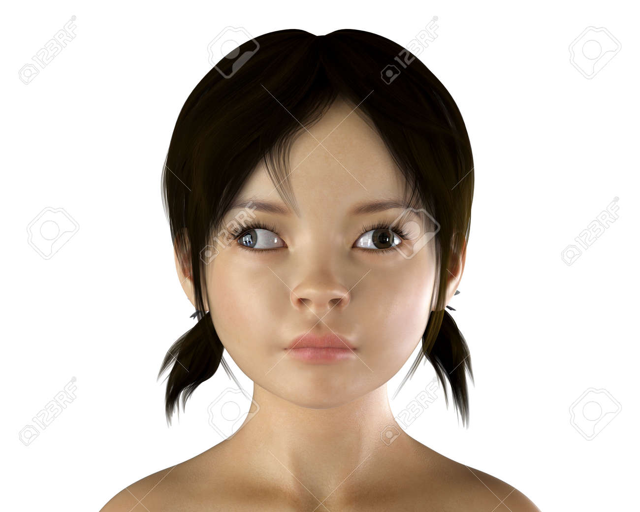 Strabismus In Children 3d Illustration Showing Exotropia Binocular Divergent Strabismus A Type Of Eye Deviation When Eye Turns Outward Stock Photo Picture And Royalty Free Image Image