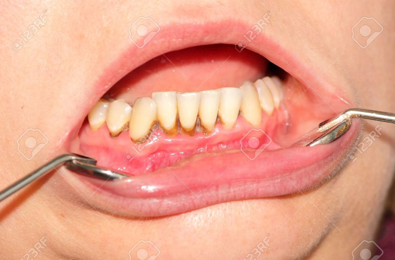 teeth tartar