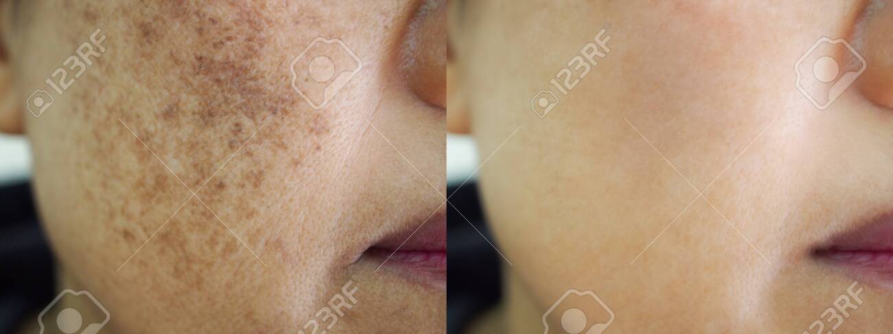 melasma facial