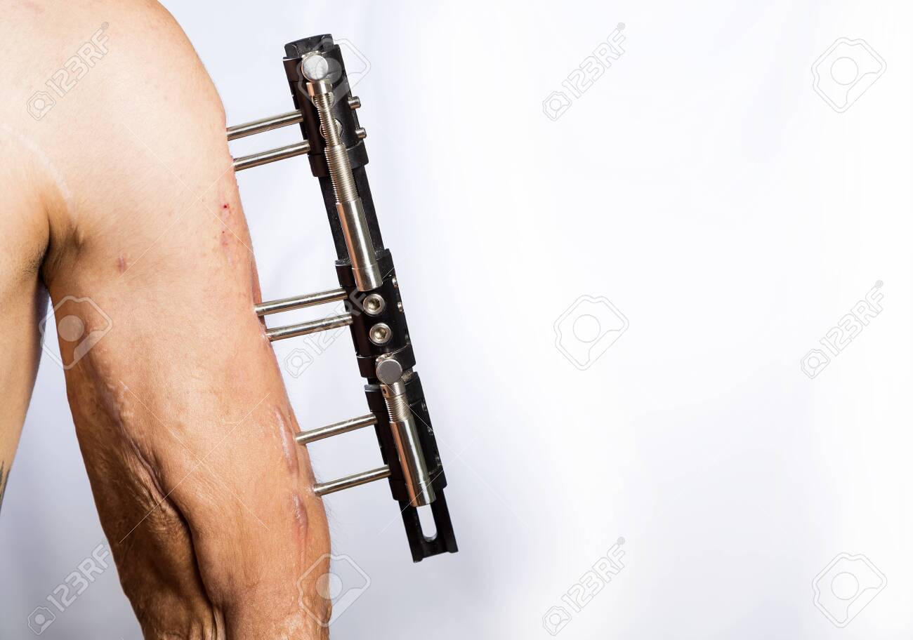 Broken Arm With External Metal Fixator White Background Stock Photo Picture And Royalty Free Image Image 141682151