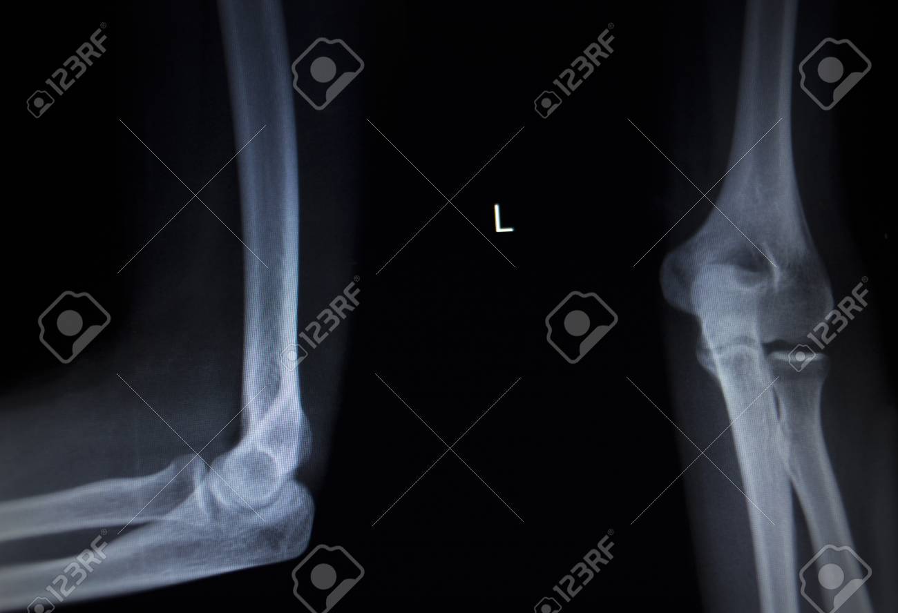 eiaculazione dolorosa x ray release eiaculazione dolorosa x ray release