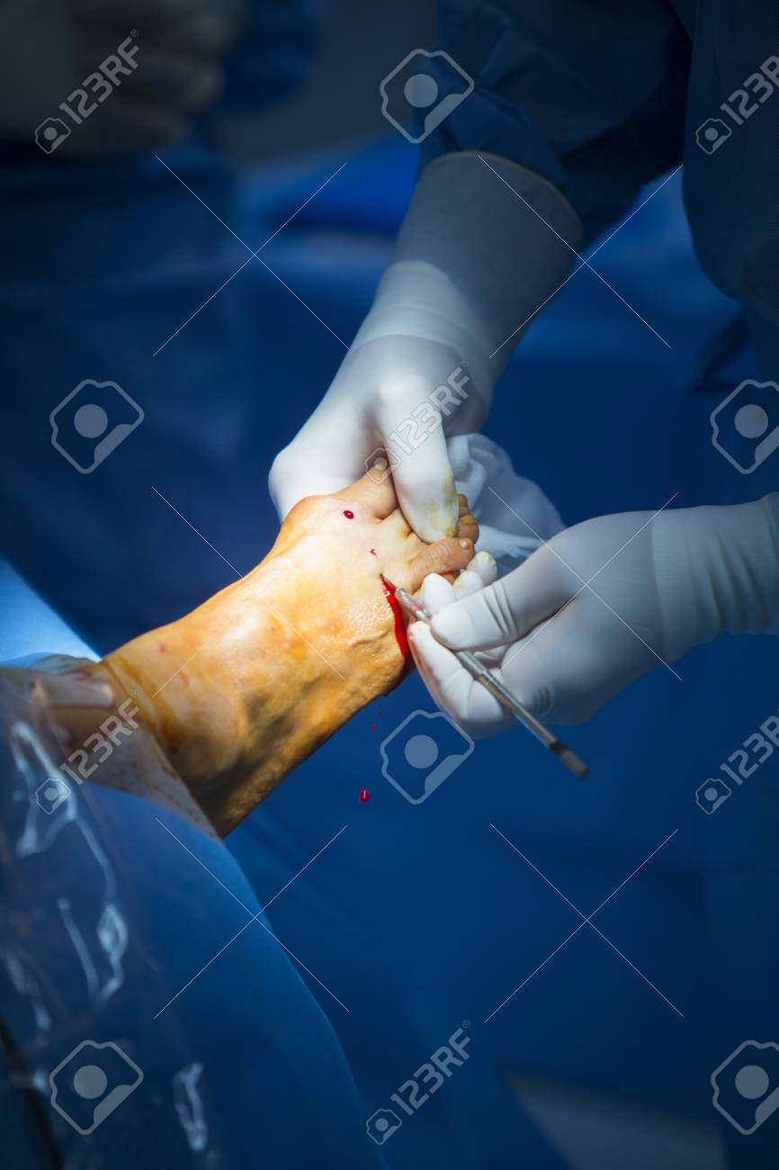 病院緊急整形外科 外傷手術手術室診療実生活写真足 足首および下腿関節鏡の整形手術で の写真素材 画像素材 Image