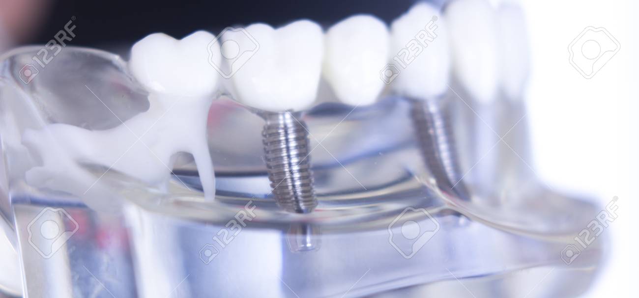 Insertable teeth: peculiarities of dental prosthetics Insertable teeth: peculiarities of dental prosthetics