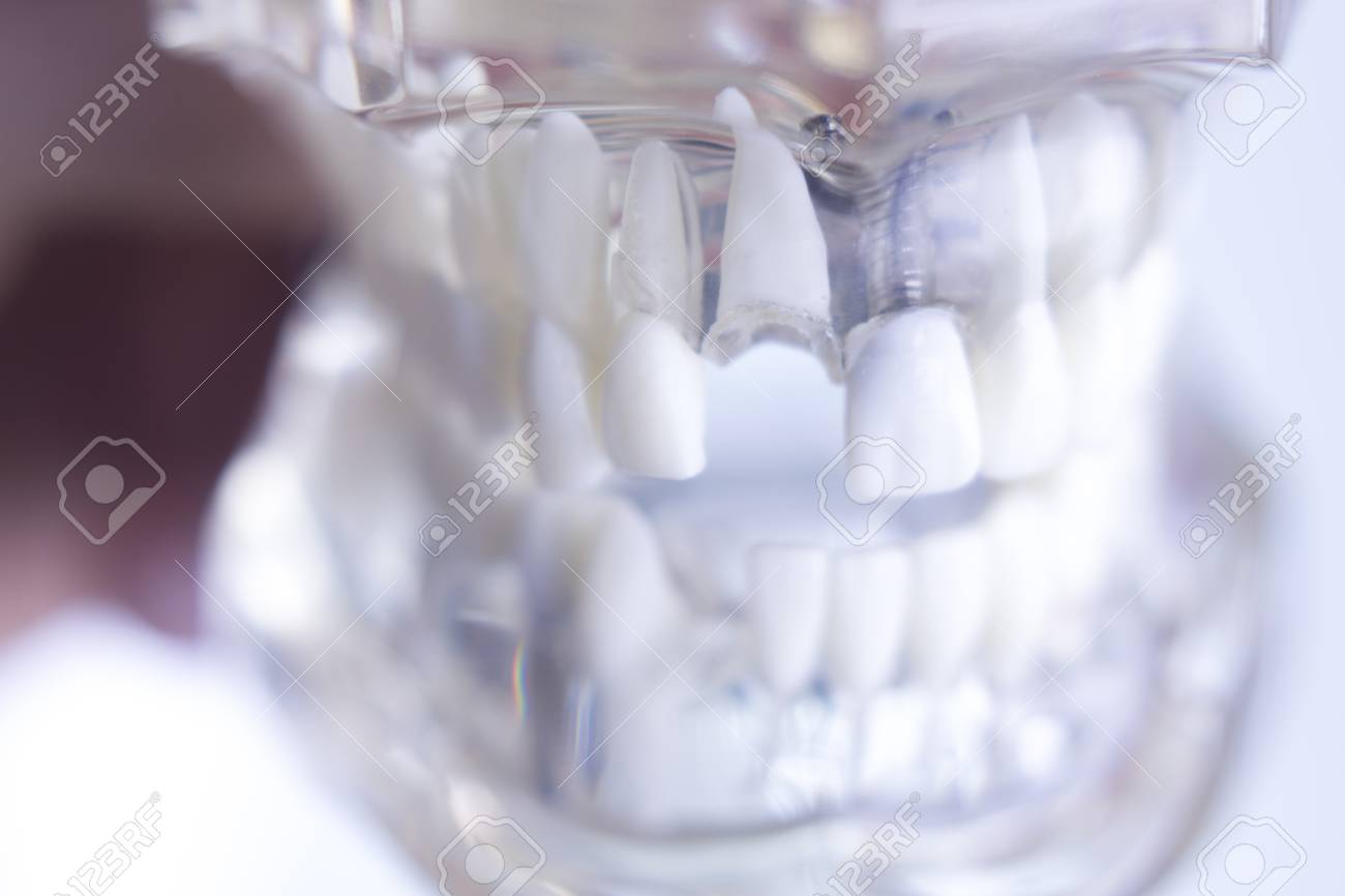 Insertable teeth: peculiarities of dental prosthetics Insertable teeth: peculiarities of dental prosthetics