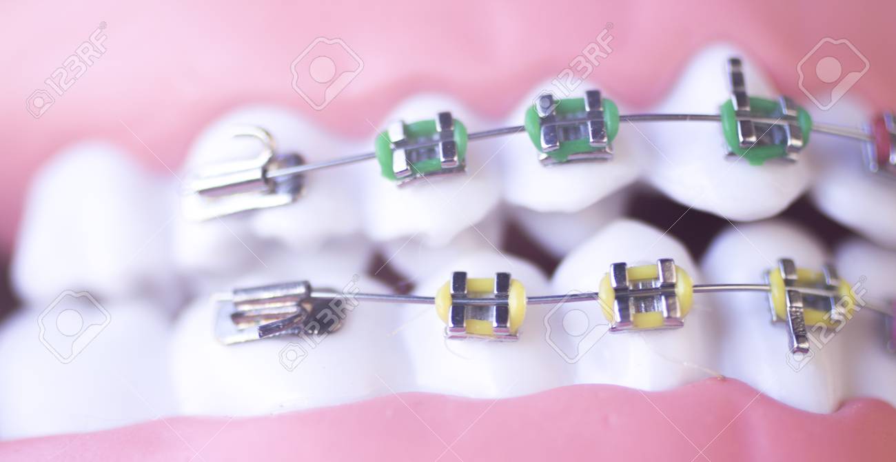 cosmetic dentistry orthodontics dental metal wire teeth brackets teaching student model stock photo 92474443