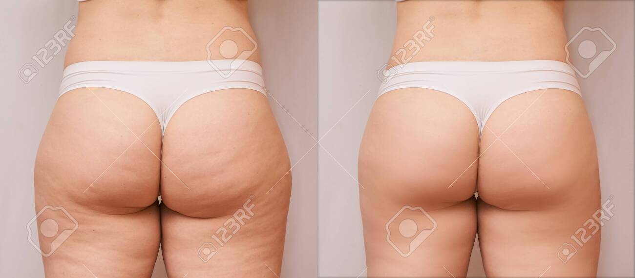 Fat Cellulite Butts Fat Cellulite Butts