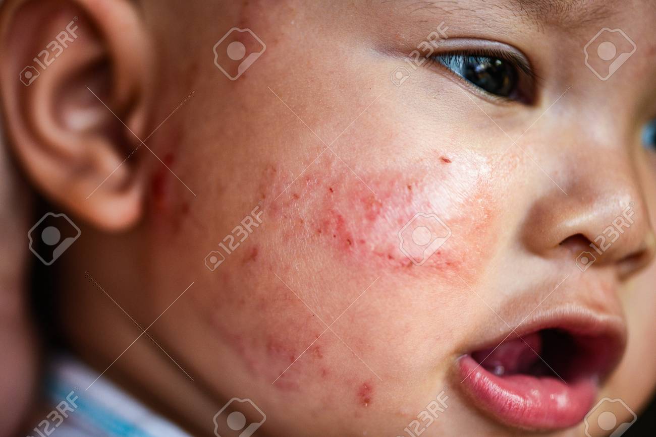 顔に発疹赤ちゃんアレルギー 病気の女の赤ちゃんは 新生児アジアのアレルギーから引き起こされる乾燥した皮膚のかゆみや病変に直面しています の写真素材 画像素材 Image