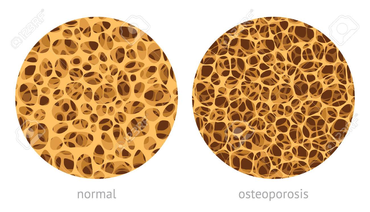 Bone spongy structure vector illustration, normal and with osteoporosis - 61740496 Bone spongy structure vector illustration, normal and with osteoporosis - 61740496