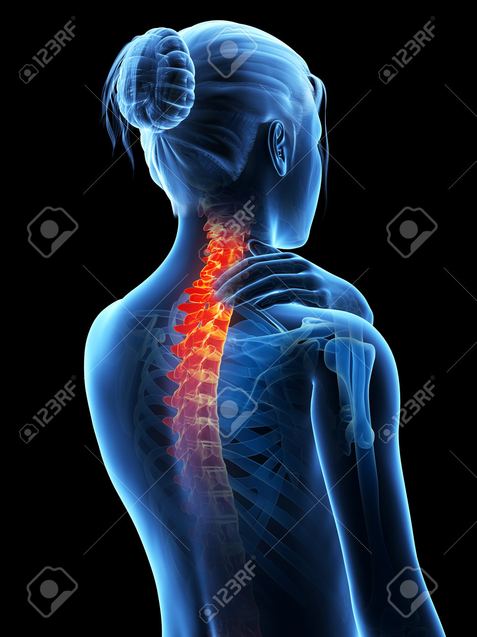 medical 3d illustration - woman having a painful neck - 26686558 medical 3d illustration - woman having a painful neck - 26686558