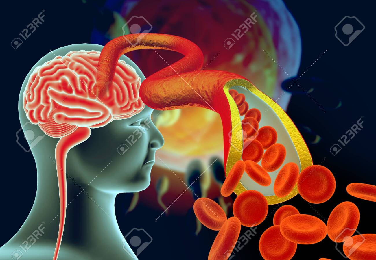 plaque in the brain plaque in the brain